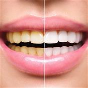 One Day Tooth Whitening Course – Incorporating Impression Taking